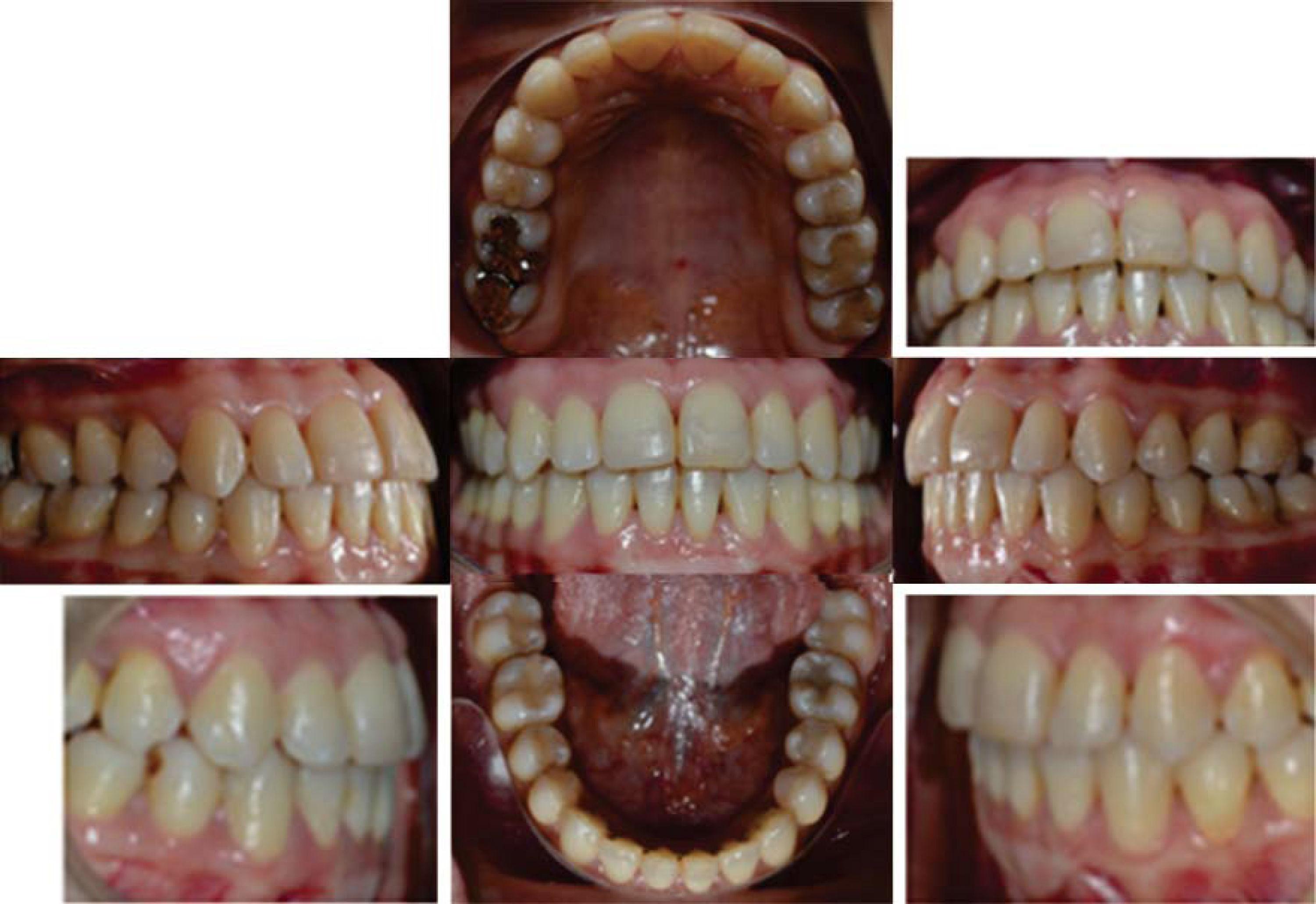 Orthodontic treatment in a periodontally compromised class III patient