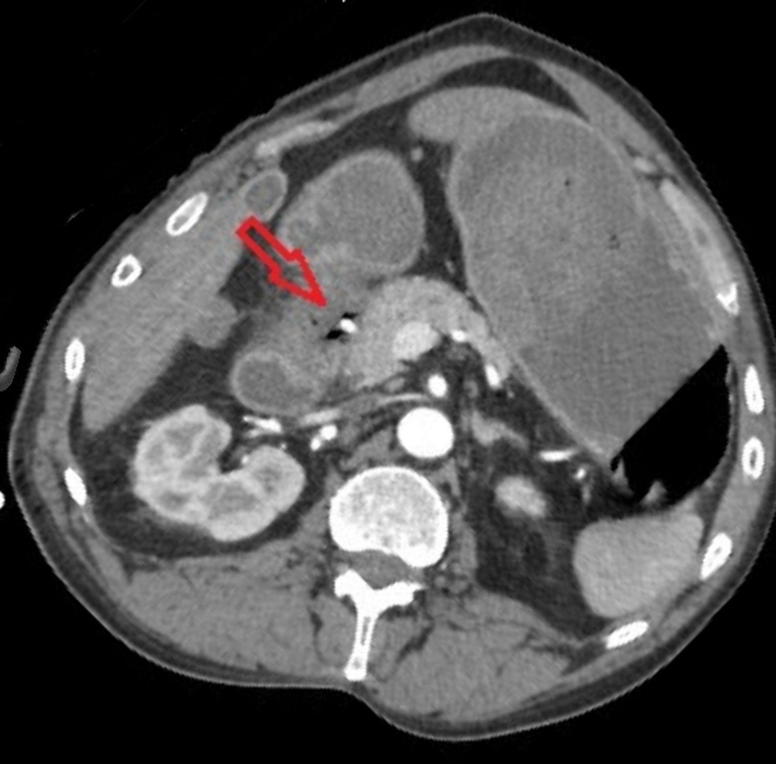 Gastroduodenal Artery Pseudoaneurysm 