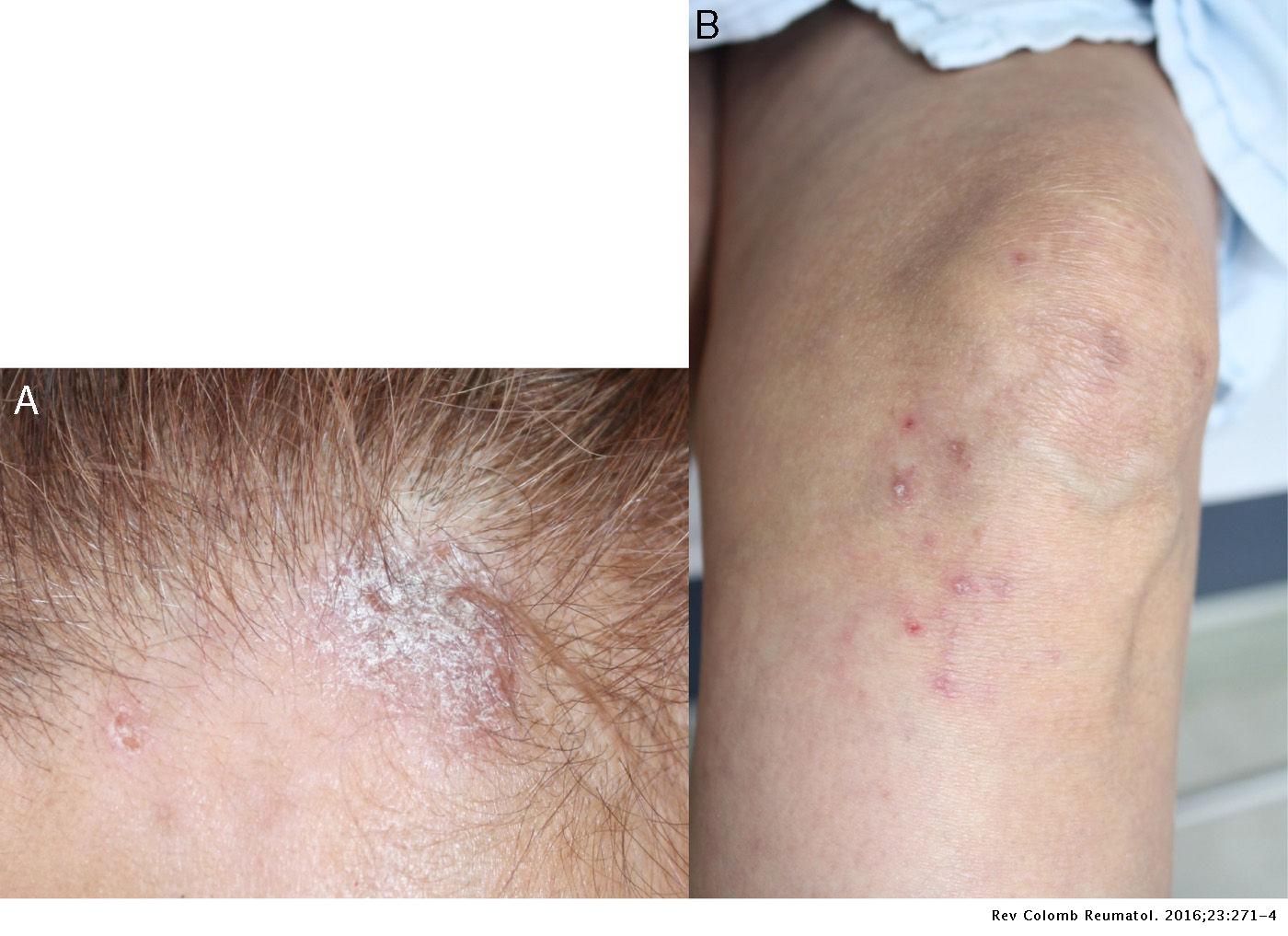 Humira Side Effects Rash