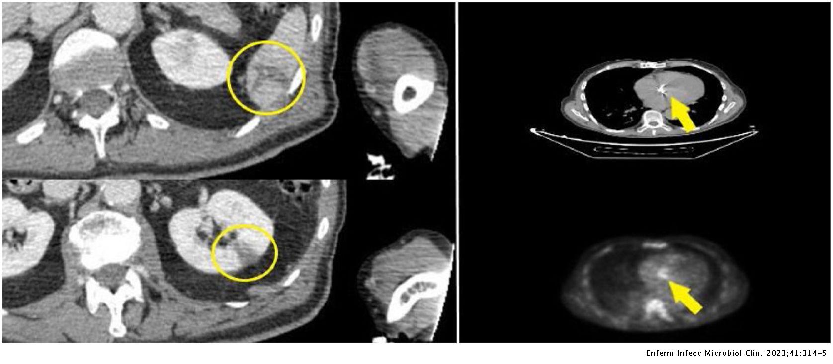 Infective endocarditis caused by Streptococcus cristatus | Enfermedades ...