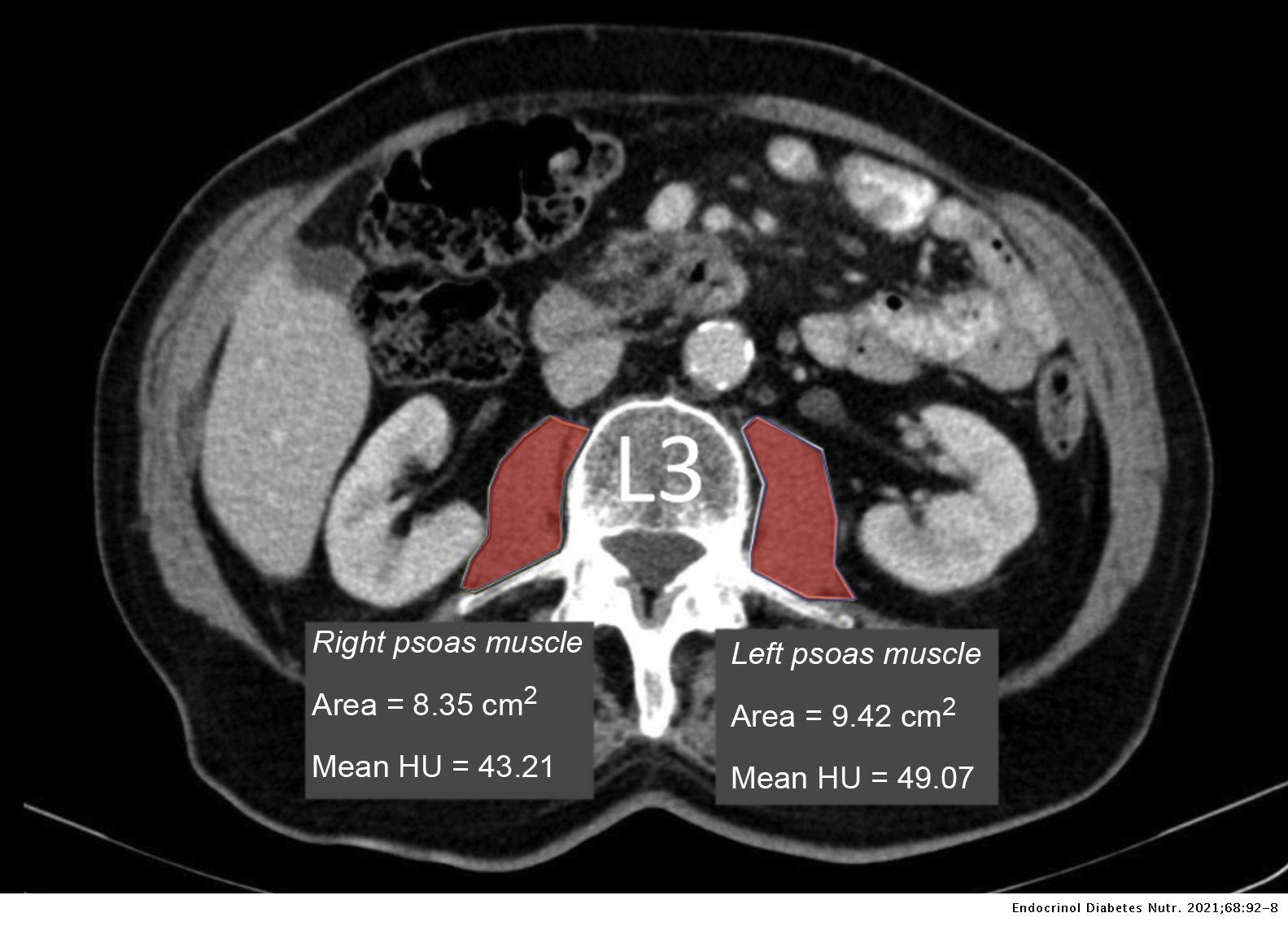 Effect of muscle density in patients with metastatic prostate cancer ...