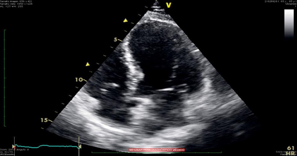 Acute stress and broken heart syndrome. A case report Revista