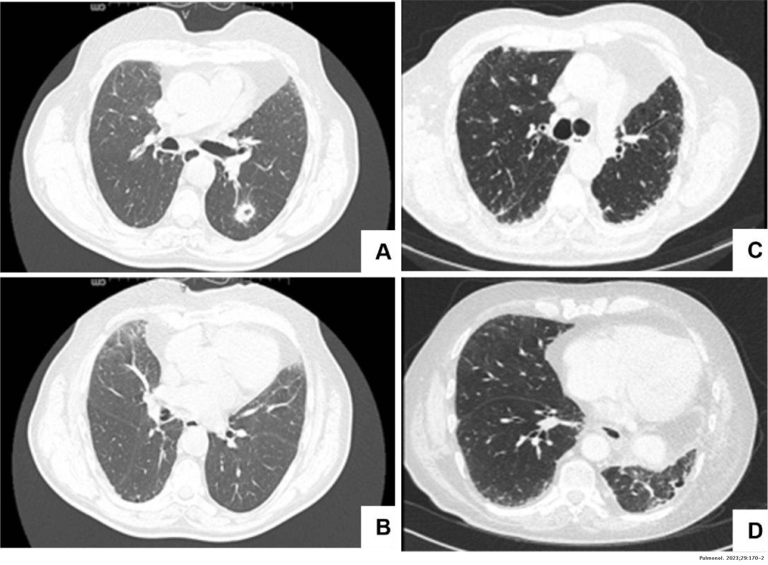 A curious manifestation of mechanical tension theory in idiopathic ...