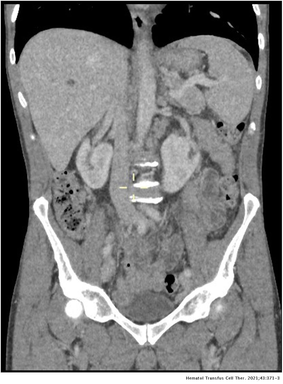 Rash in the acute setting not always easy | Hematology, Transfusion and ...