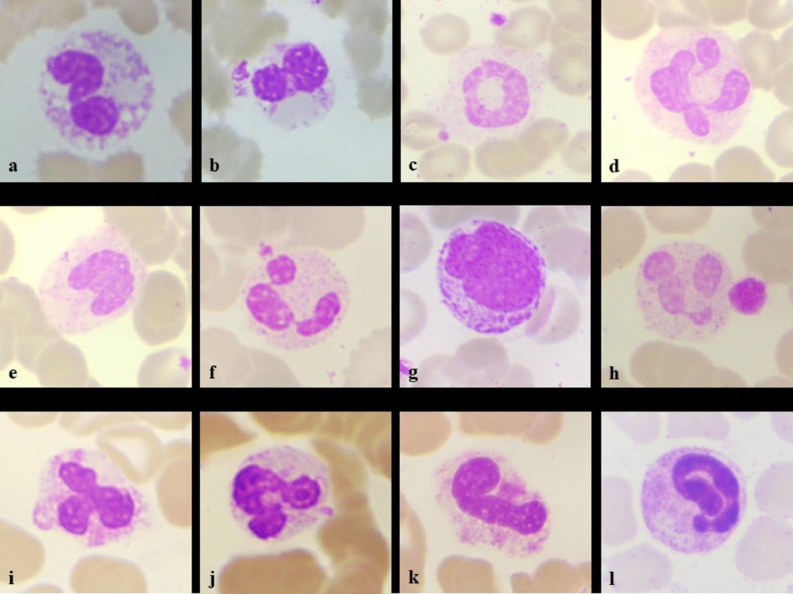 Peripheral smear in COVID 19 a case report Hematology, Transfusion