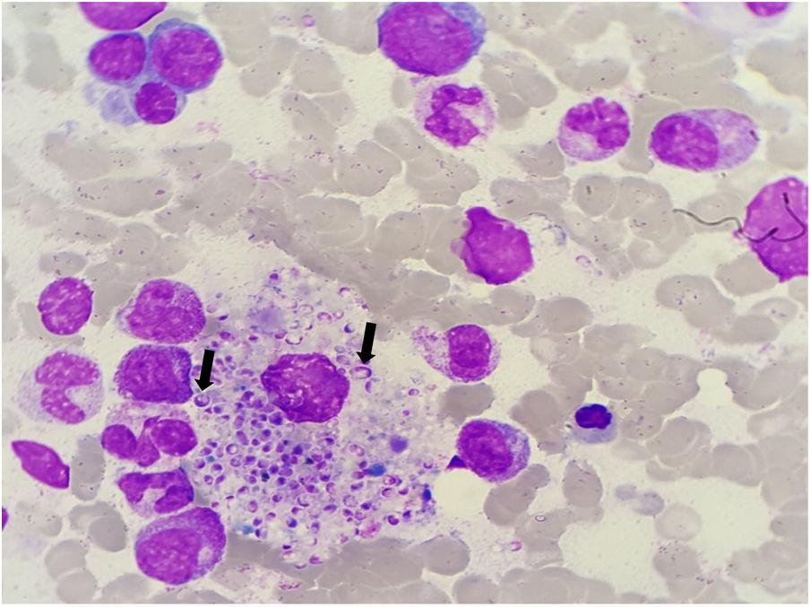 Disseminated Histoplasmosis Diagnosed In A Bone Marrow Sample