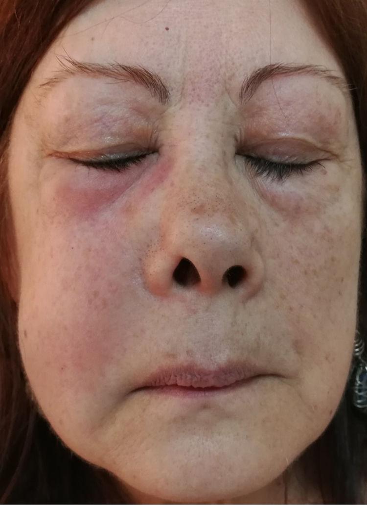 Celulitis odontógena de presentación atípica Atención Primaria Práctica