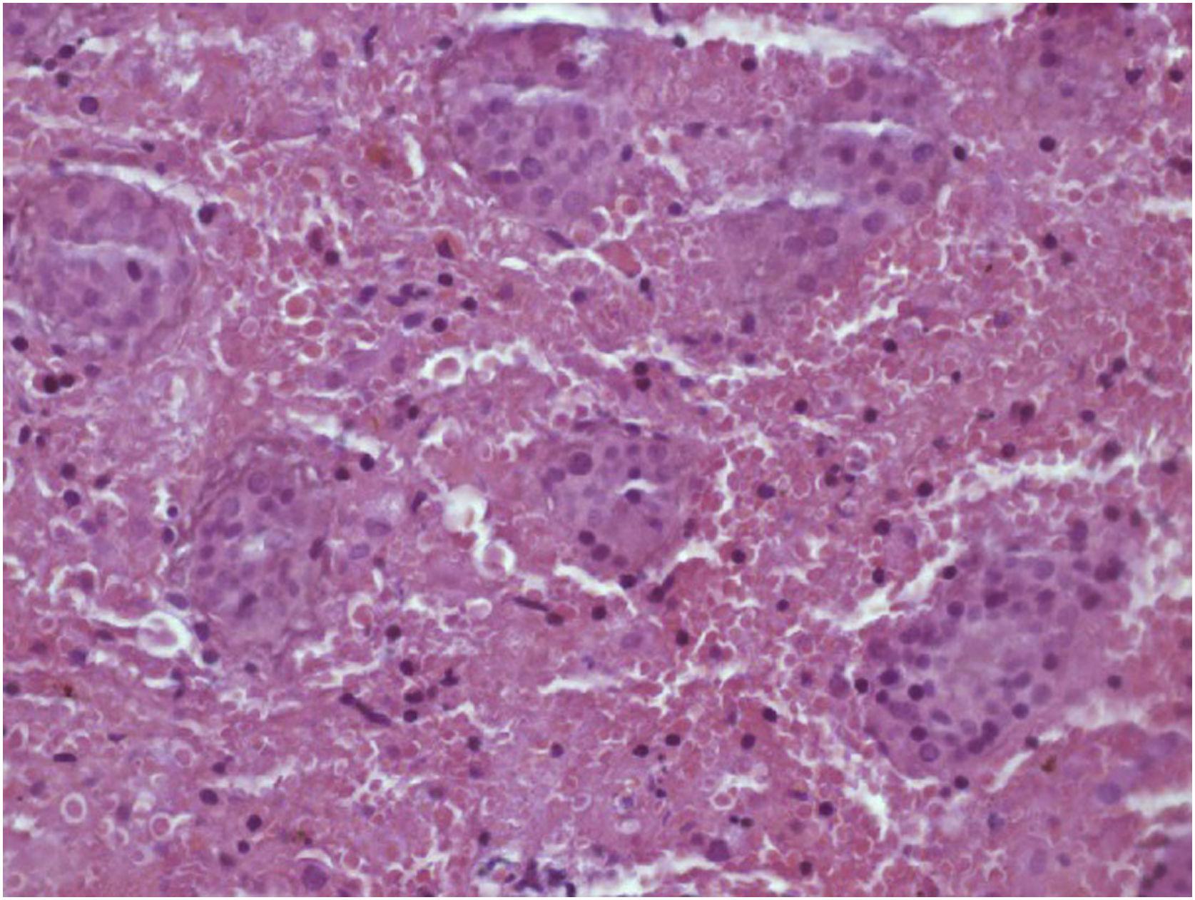 Torsión testicular inútero en un paciente recién nacido Atención Primaria Práctica