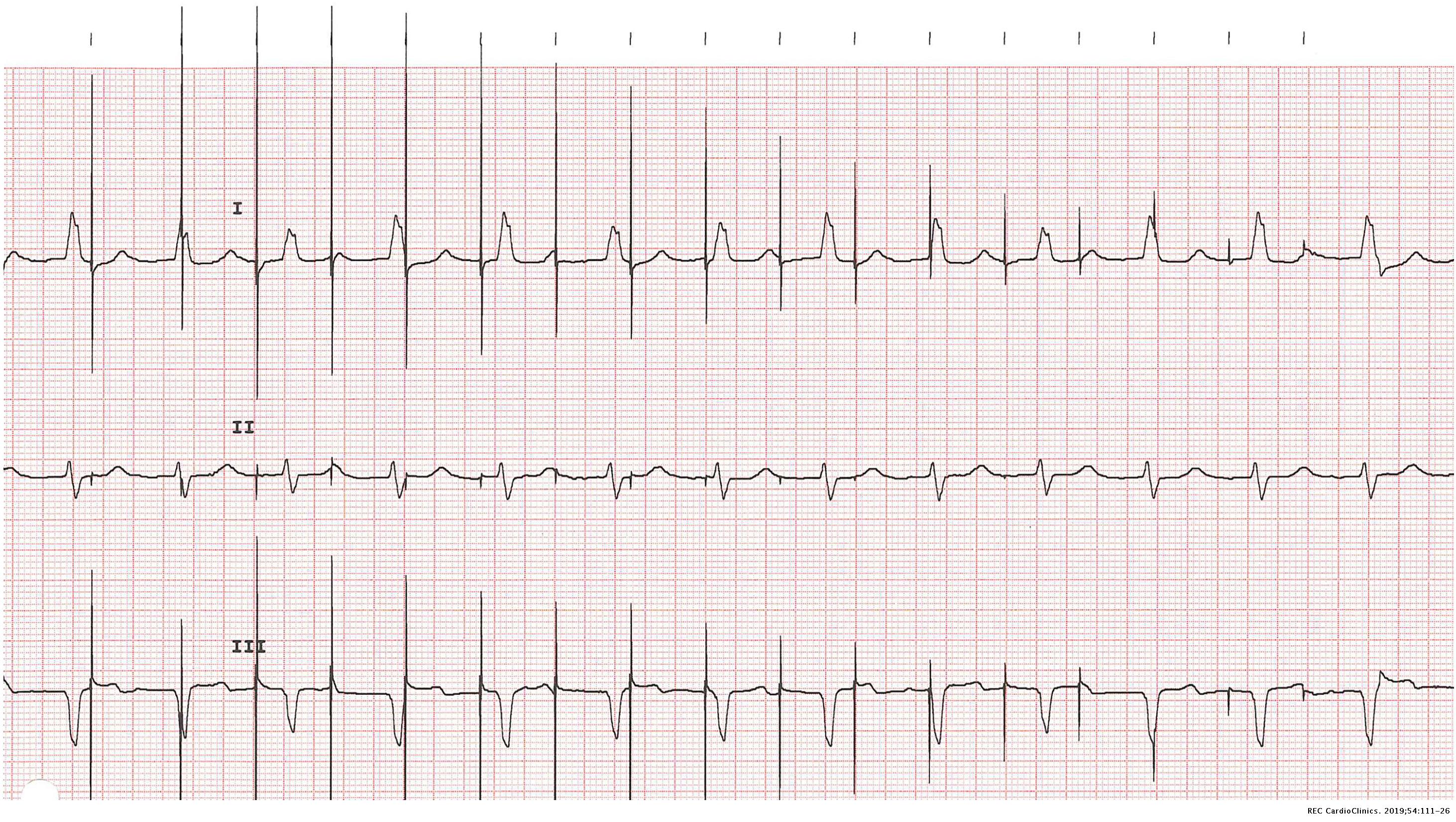 Advanced pacing algorithms resembling device malfunction: A ...