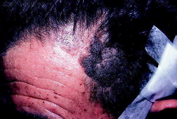 Arqueológico Endulzar Redondear a la baja Semiología de las dermatosis de cuero cabelludo | Medicina Integral