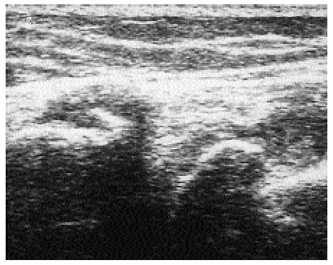 Role of ultrasound in osteoarthritis | Revista Española de Reumatología