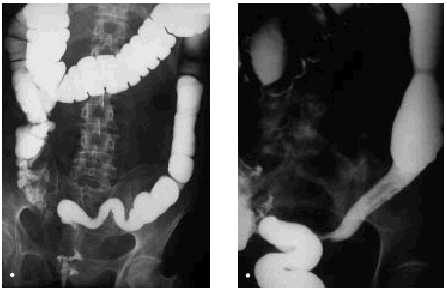 Lesiones Intestinales De La Radioterapia Gastroenterologia Y Hepatologia