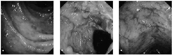 Lesiones Intestinales De La Radioterapia Gastroenterologia Y Hepatologia