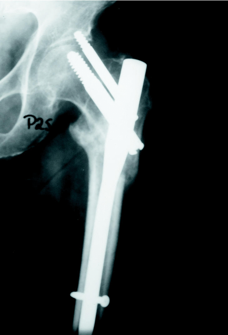 Clavo Femoral Proximal De Ao Asif Pfn En El Tratamiento De Las Fracturas De La Region Trocanterea Y Subtrocanterea Del Femur Revista Espanola De Cirugia Ortopedica Y Traumatologia