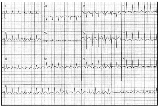 Pulmonary Vein Ablation in Atrial Fibrillation. Initial Experience ...