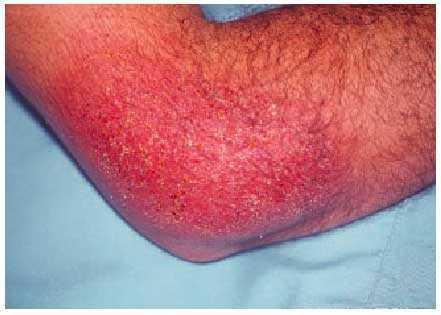 Cambiable Completo sarcoma Dermatitis de contacto. Alergia e irritación | Farmacia Profesional