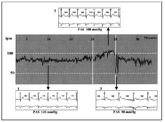 Tilt Test (TTPD2 A/V) - Gardhen Bilance