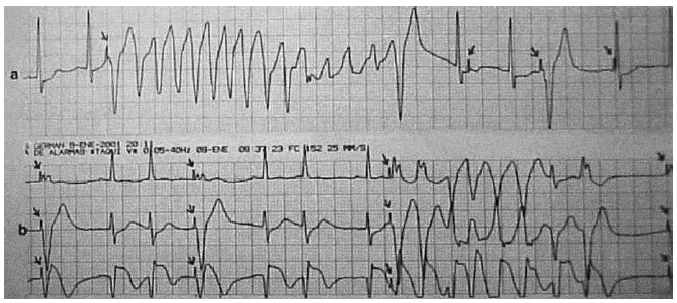 Taquicardias Ventriculares Polimorfas Inducidas Por Marcapasos Temporales Transvenosos Medicina Intensiva