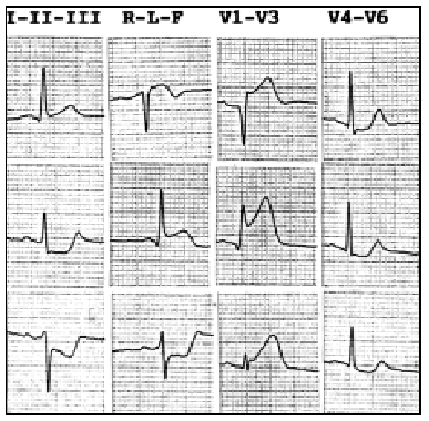 Electrocardiographic Prediction Of The Site Of Lesion In The Anterior Descending Artery In Acute Myocardial Infarction Revista Espanola De Cardiologia