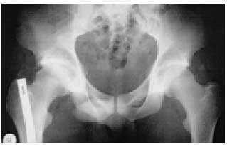 images Radiografia De Cadera Normal radiografia osea medicina integral