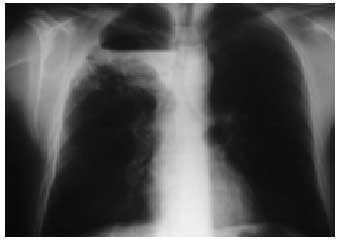 Radiografía de tórax | Medicina Integral