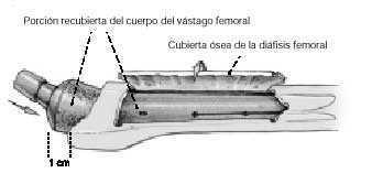 Cubierta ósea anterolateral para revisión de artroplastia de cadera
