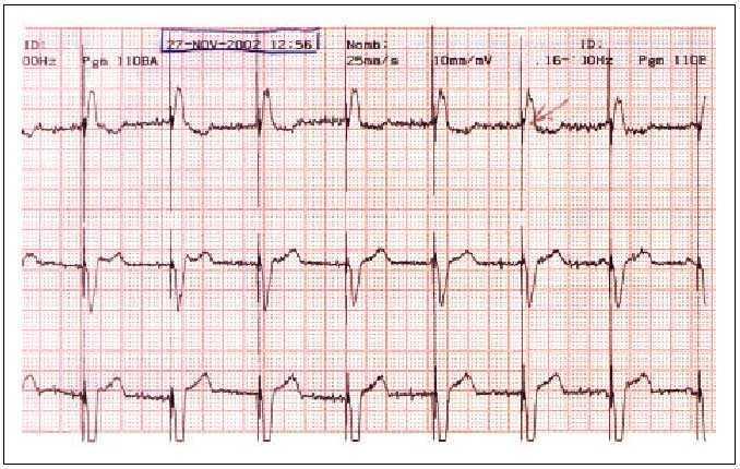 Los Marcapasos Cardiacos Medicina Integral