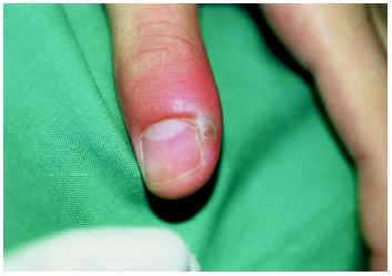 Gonococia extragenital cutánea primaria | Actas Dermo-Sifiliográficas Gonococia extragenital cutánea primaria | Actas Dermo-Sifiliográficas