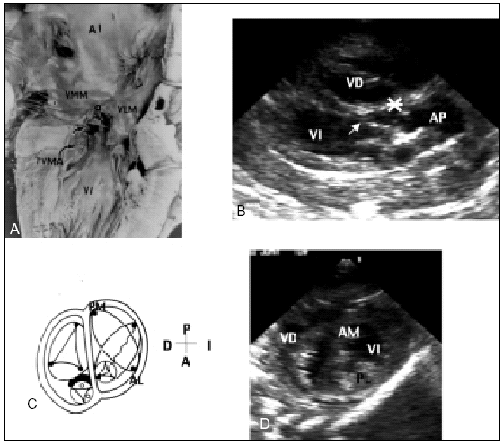 Right Ventricular Outflow Tract Obstruction