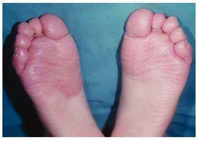 Problemas comunes de la piel de los pies. y tratamiento | Farmacia Profesional