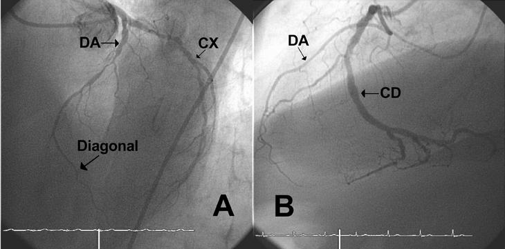 Doble Arteria Descendente Anterior Tipo Iv Revista Espanola De Cardiologia