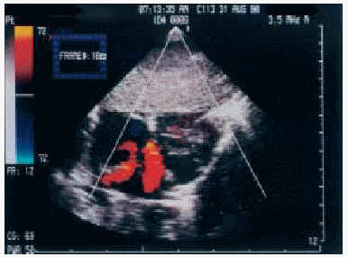 Heart Malformations In Children With Down Syndrome Revista Espanola De Cardiologia