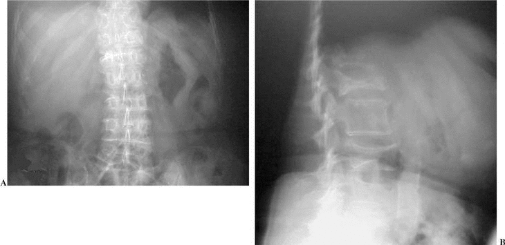 Vertebroplastia Percutanea Para El Tratamiento De Las Fracturas Vertebrales Por Compresion De Origen Osteoporotico Revista Espanola De Cirugia Ortopedica Y Traumatologia