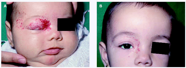 Tratamiento De Hemangiomas Infantiles Con Corticoides Orales Actas Dermo Sifiliográficas 3223