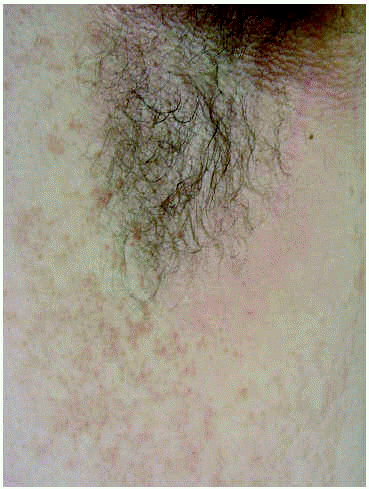 que es la papilomatosis confluente y reticulada hpv skin wart