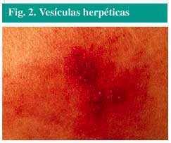 Herpes | Farmacia Profesional
