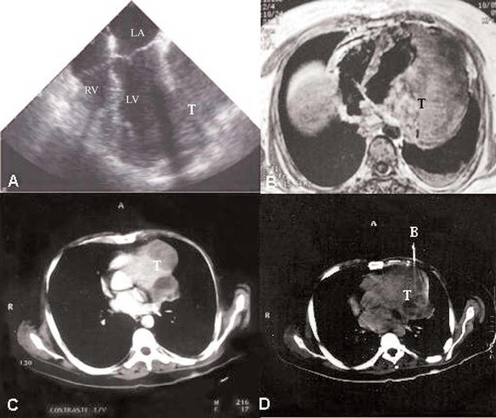 Primary Cardiac Angiosarcoma Diagnostic Utility Of Computed Tomography And Cardiac Magnetic Resonance Revista Espanola De Cardiologia