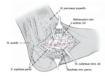 Ízületi porckopás (artrózis) - Tünetek és okok - A jobb boka ízület posztraumás artrózisa