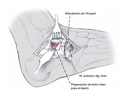A jobb boka ízület posztraumás artrózisa