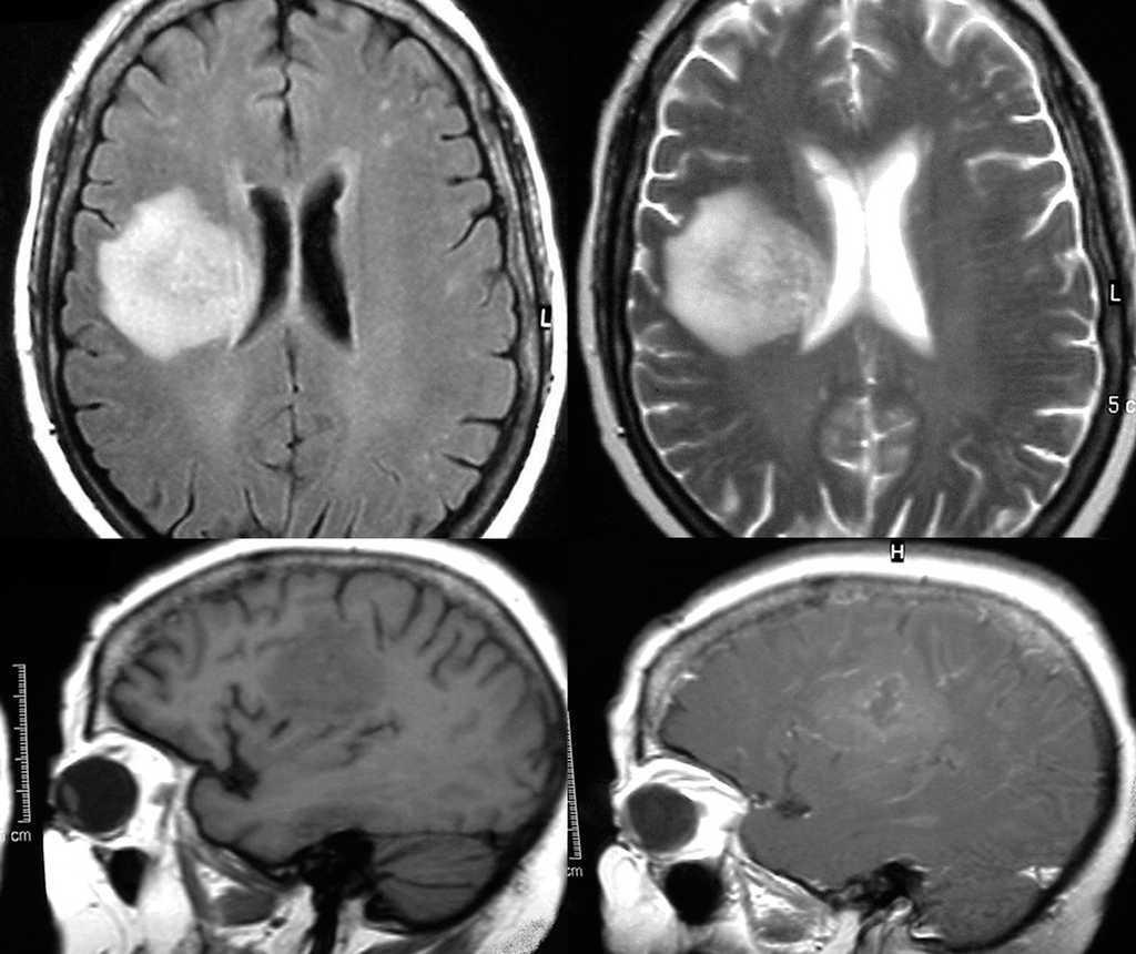 Almacén Premisa Del Sur absceso cerebral tac hierro Típicamente Rudyard ...