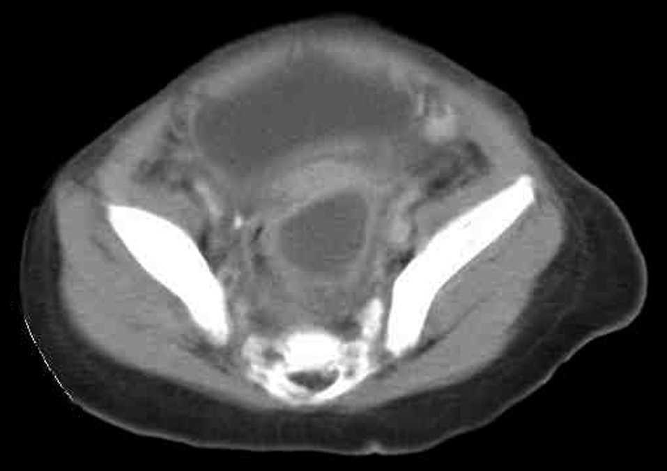 Apendicitis En Un Lactante Un Diagnostico En Ocasiones Dificil Anales De Pediatria