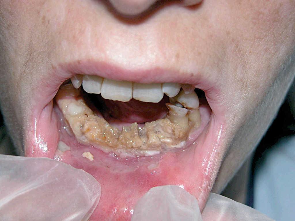 Dolor bucal y pérdida de piezas dentarias en mujer de 36 años