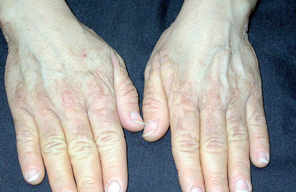 Tutor golondrina riqueza Pápulas verrugosas en el dorso de las manos | Actas Dermo-Sifiliográficas