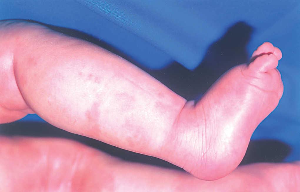 Que Es Un Edema Niños Que Es Un Edema Niños