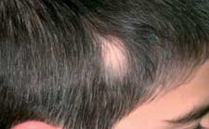 Alopecia Triangular Congenita Anales De Pediatria English Edition