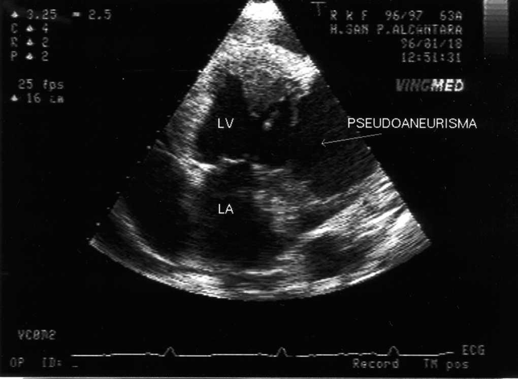 Silent Left Ventricular Pseudoaneurysm and Rupture to a Second Pseudoaneurysm | Revista Española ...