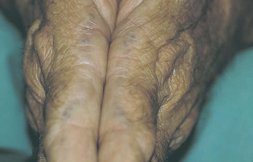 Ocronosis endógena descripción de un caso Actas DermoSifiliográficas Ocronosis endógena descripción de un caso Actas DermoSifiliográficas