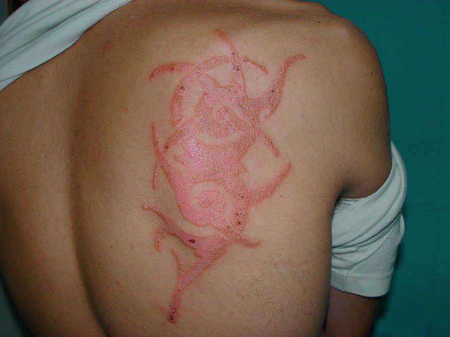 Riesgos de los tatuajes de henna negra | Anales de Pediatría