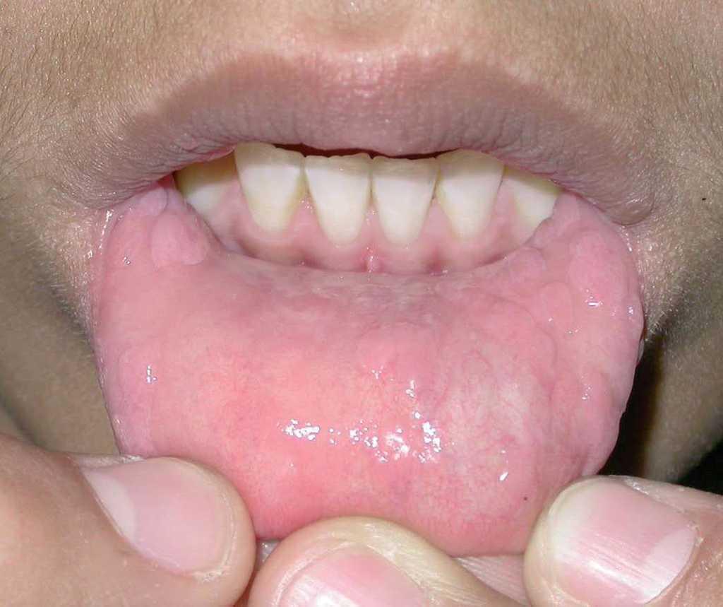 papiloma en los labios dela boca tratamiento