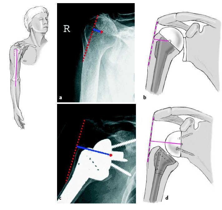 Tratamiento de la artropatía por defecto mediante prótesis invertida de